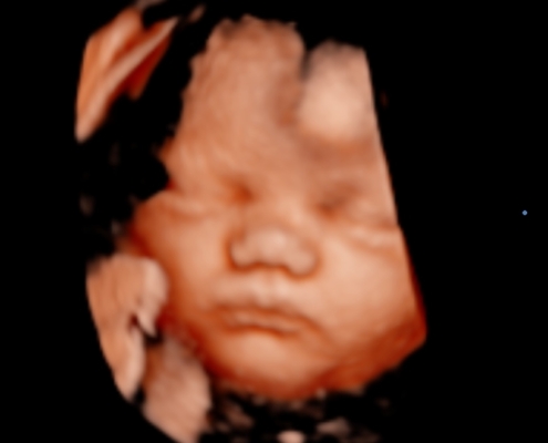 Ultrasound Photo